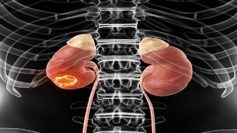 كشف أعراض نوع من السرطان يصعب تشخيصه