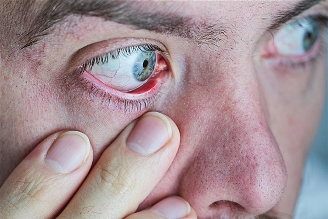 5 أعراض في الوجه تشير إلى الإصابة بالسكري