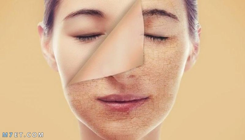 5 أسباب تسبب البشرة الدهنية