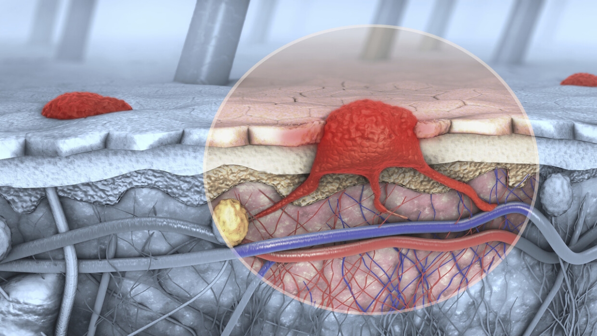 تحسس رأسك!.. عارض غريب لسرطان الجلد يظهر قبل عامين من تشخيصه