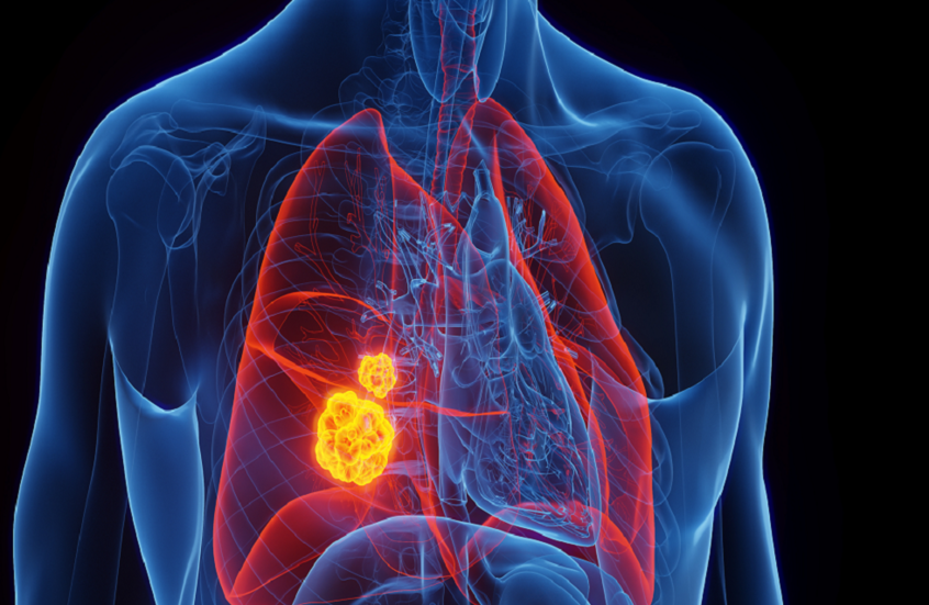 عامل خفي يحدث طفرات في حمضنا النووي ويسبب السرطان لدى غير المدخنين