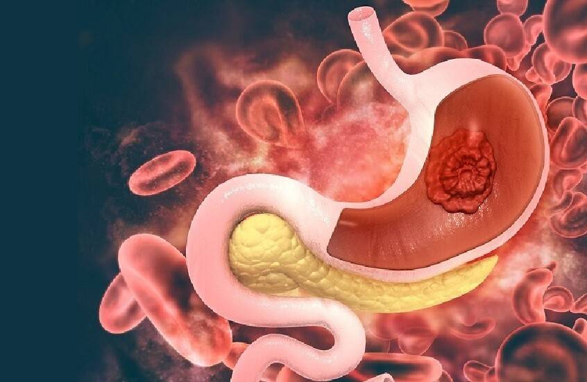 العامل الرئيسي لتطور سرطان المعدة