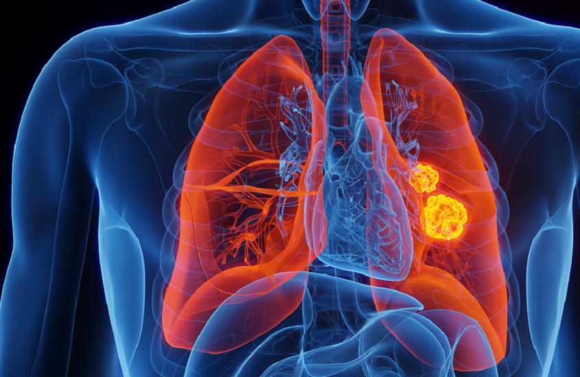 عرض صحي قد يكون مؤشرا على الإصابة بسرطان قاتل!