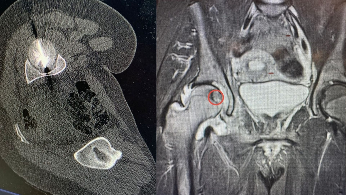 تدخل علاجي نوعي في مستشفى الجامعة لعلاج ورم في رأس عظم الفخذ