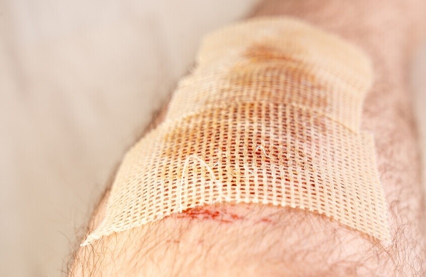 دراسة روسية تكشف ارتباطا بين القلق وتأخر التئام الجروح