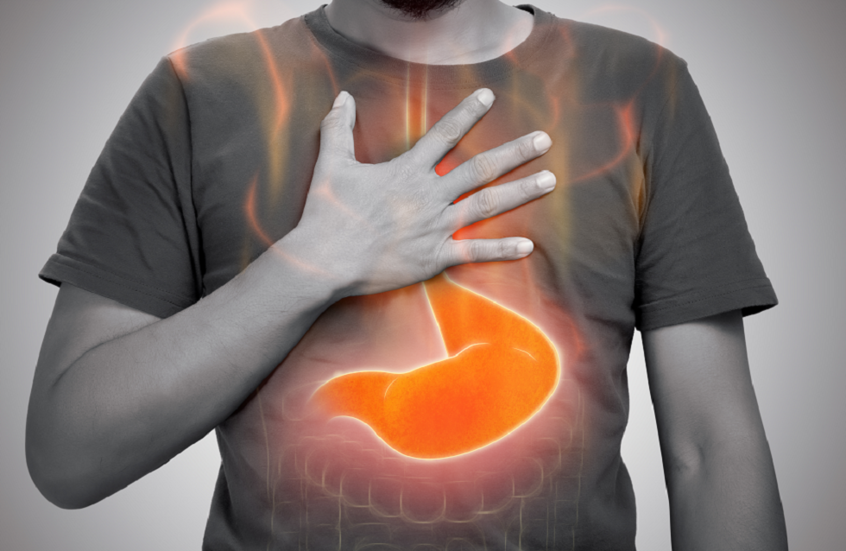أسباب غير متوقعة لحرقة المعدة